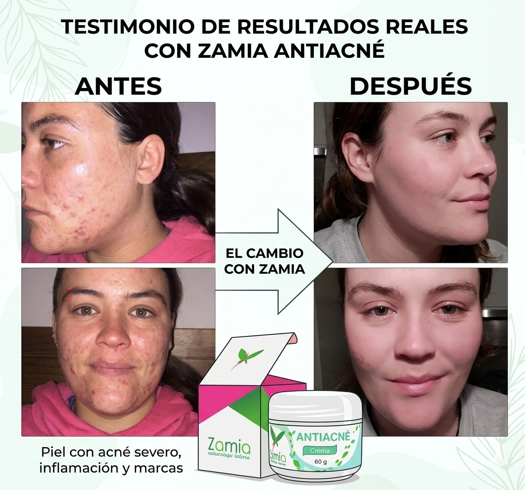 ZAMIA CREMA ANTIACNÉ ORIGINAL (60g)